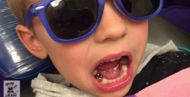 White Crowns On Toddler Teeth Procedure
